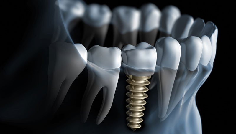 Dental Implants in Lewisville, NC. Dr. Joel Manchego, DDS, Manchego Dental