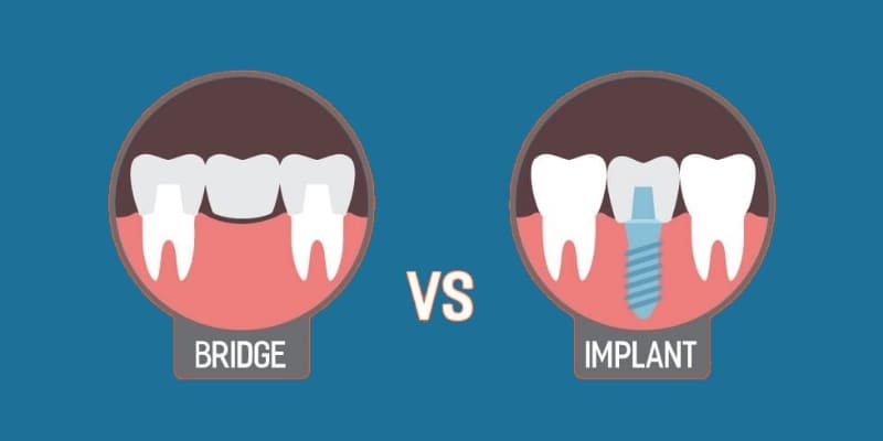 Dental Implant vs Dental Bridge. Dentist in Lewisville, NC. Dr. Joel Manchego, DDS, Manchego Dental