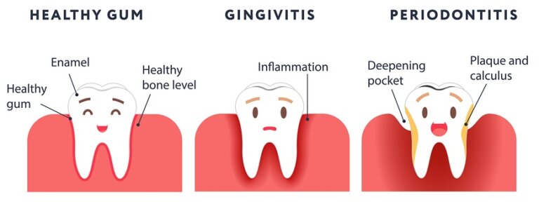 Understanding Gum Disease. Dentist in Lewisville, NC. Dr. Joel Manchego, DDS, Manchego Dental