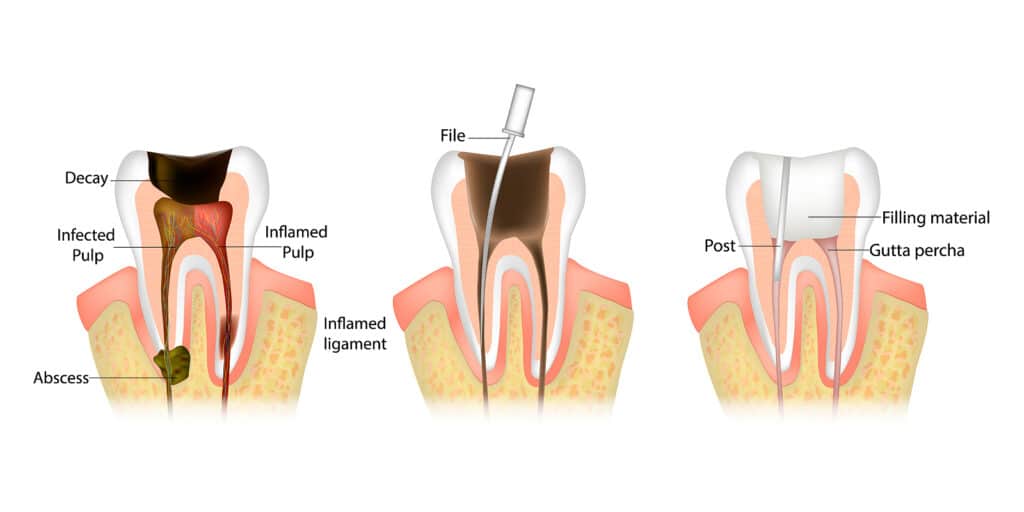 So Your Tooth Needs a Root Canal, But Is It Worth It? Dentist in Lewisville, NC. Dr. Joel Manchego, DDS, Manchego Dental